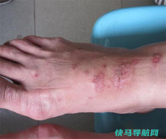脚上起小水泡怎么根治 第2张